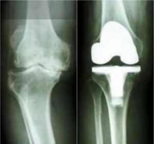 TKR (Total Knee Replacement)